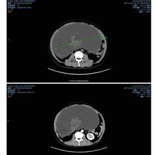 An Abdomen Computed Tomography Scan Revealed A Giant Cystic Mass In The