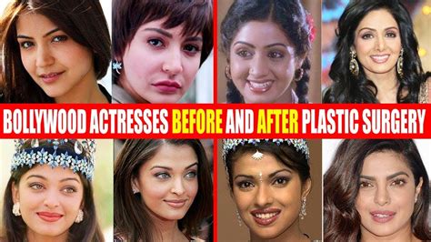 Indian Celebrity Botox Before And After