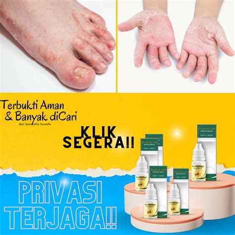 Jual Obat Telapak Tangan Kasar Obat Jari Tangan Kering Jari Kaki