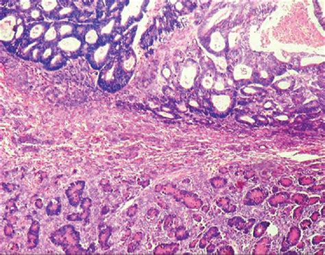 Sertoliform Endometrioid Tumor Of Ovary Presenting As Torsion Journal