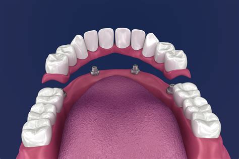 Dental Implants Kent Tooth Implant Dartford Cosmetic Dentist Dartford