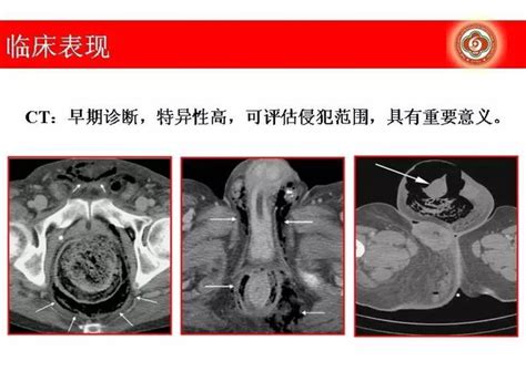 干货︱急性坏死性筋膜炎的诊治与创面修复：（上） 搜狐