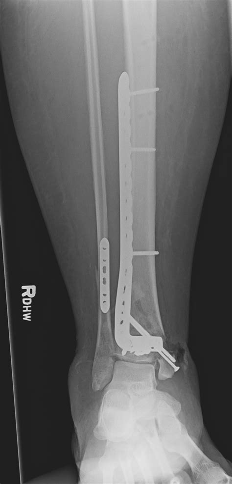 Figure Postoperative Ap X Ray Shows Placement Statpearls Ncbi