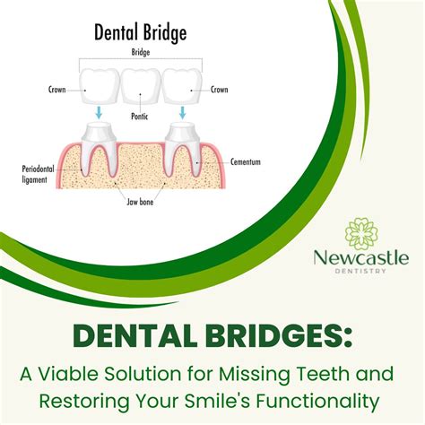 Dental Bridges In Newcastle Restoring Your Smile And Oral Flickr