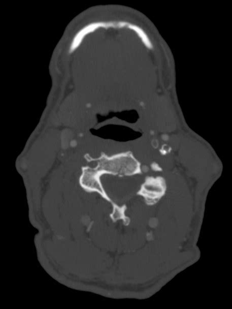 Bilateral Carotid Artery Stenosis Vascular Medicine