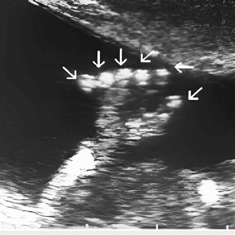 Level Ii Ultrasound Scan Showing Polydactyly Download Scientific Diagram