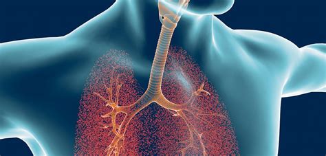 SmartVest System Leads To Long Term Benefits For Bronchiectasis