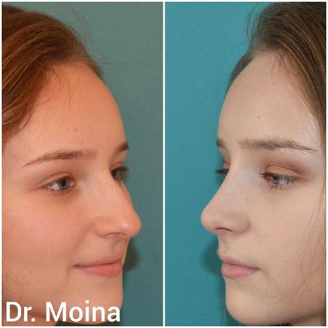 Before And After Photos Of A Woman S Nose Surgery With Rhinoplasts