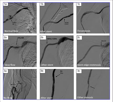 Figure 1 From Use Of The Viabahn Covered Stent For The Treatment Of