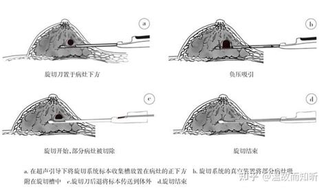 宁夏中卫也能做腔镜乳腺癌手术啦——中卫支医记事第九周1214 知乎