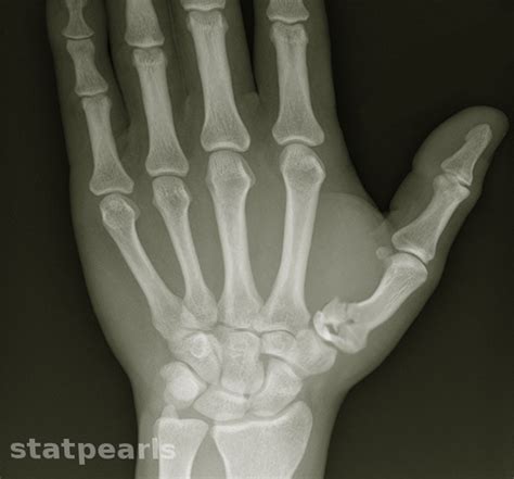 Figure Rolando Fracture Image Courtesy Dr Chaigasame Statpearls