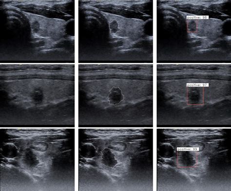 Labeled Thyroid Ultrasound