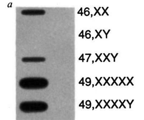 Expression Of The Xist Gene In Males Females And Somatic Cell Hybrids