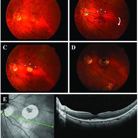 Representative Eye Before And After Limited Macular Translocation