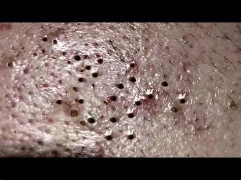 Satisfying Blackheads Removal Acne Treatment Big Blackheads Guide For