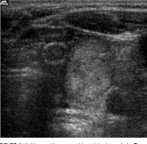 Albums 103 Pictures Pictures Of Thyroid Nodules On An Ultrasound Superb