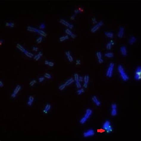 Result Of The Conventional Cytogenetic Analysis On Gtg Banded