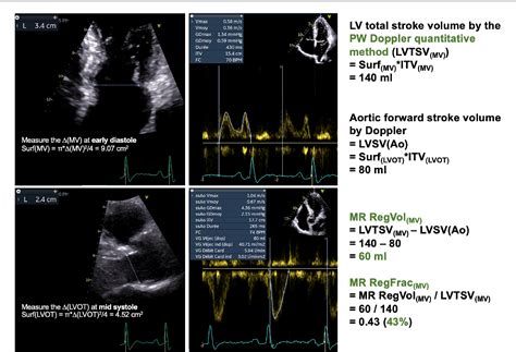 Figure From Quantification Of Primary Mitral Regurgitation By