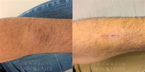 Cyst And Lipoma Removal Before And Afters Franklin Skin And Laser