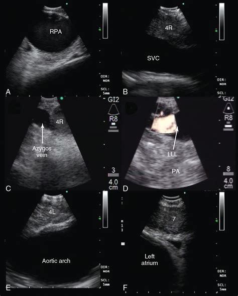 Endobronchial Ultrasound Consultant Level Examination Clinical Tree