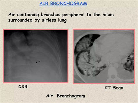 Chest Radiology.ppt