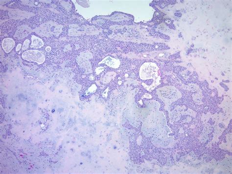 Pathology Outlines Chondroid Syringoma