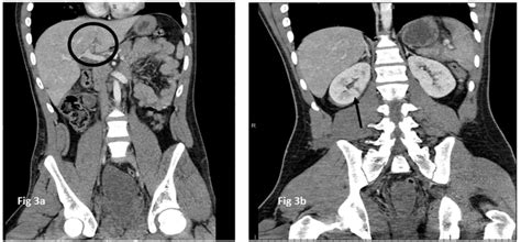 A Grade 1 Liver Laceration A Highlighted In The Solid Black Circle