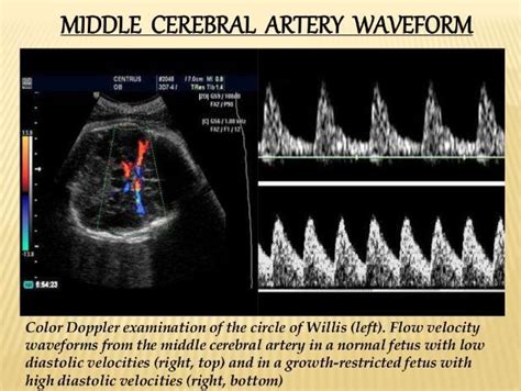 Middle Cerebral Artery Doppler