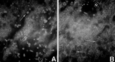 Acanthamoeba Keratitis Confocal