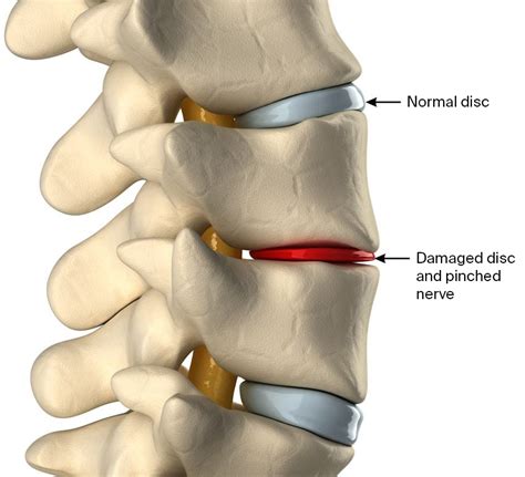 Degenerative Disc In Thoracic Spine