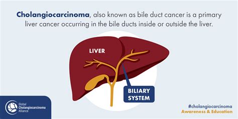 Bile Duct Cancer