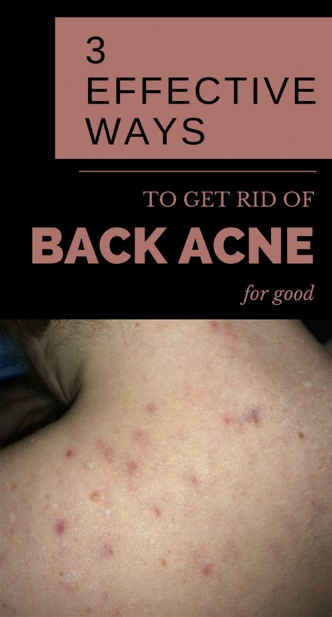 How to get rid of back acne fast naturally – Artofit