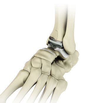 Total Ankle Arthroplasty Chapel Hill NC Ankle Arthritis Raleigh