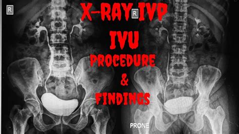 X Ray Ivp Xray Ivu Procedure Indications Findings Intravenous