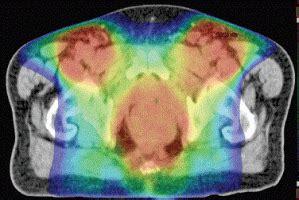 IMRT RapidArc And Conformal Radiotherapy In The Treatment Of Tumours Of The Anal Canal Ecancer