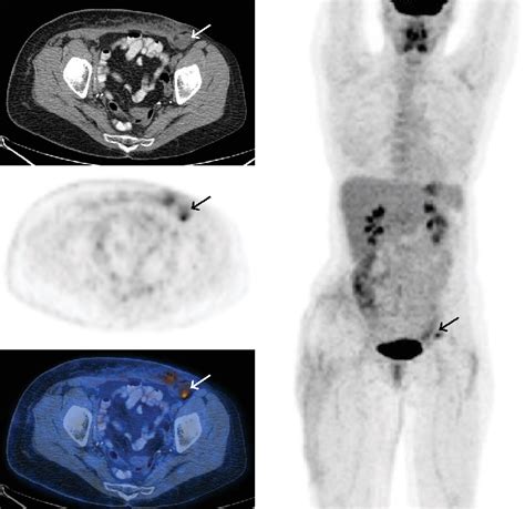 PDF FDG PET CT In Initial Staging Of Adult Soft Tissue Sarcoma