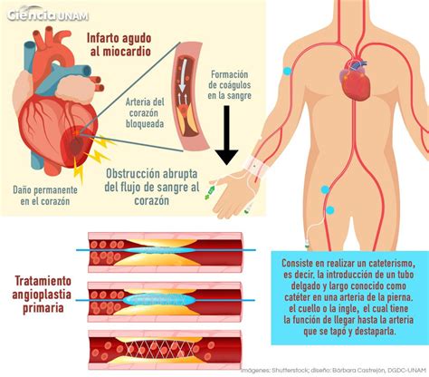 Infarto Agudo De Miocardio Causas Síntomas Y Tratamiento Infobae