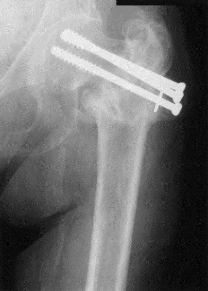 Basal Fractures Of The Femoral Neck Intra Or Extra Capsular Injury