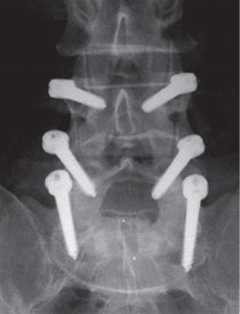 Lumbar Spine Fusion and Stabilization: Hardware, Techniques, and