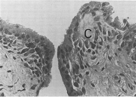 Case 12 Photomicrograph From Synovial Biopsy Of The Knee Note Two