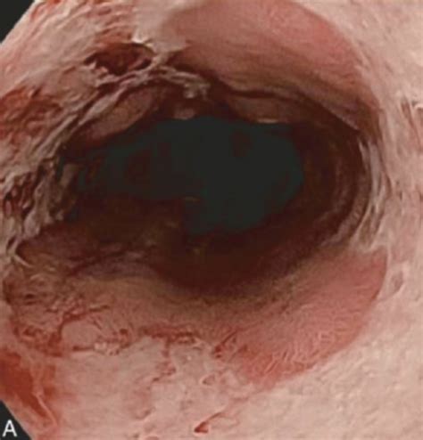 Gi Reflux Esophagus Peptic Ulcer Disease Flashcards Quizlet