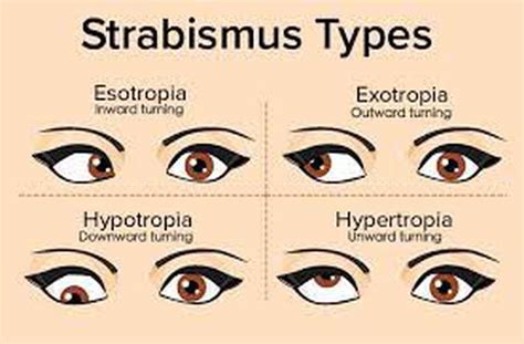 Strabismus Types Medizzy