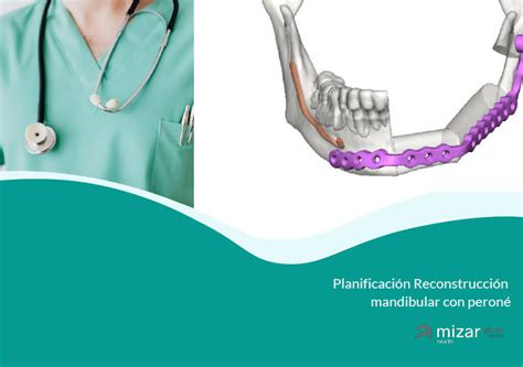 Planificaci N Reconstrucci N Mandibular Con Peron Mizar Health