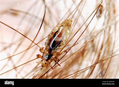 Body Louse Pediculus Humanus Humanus Crawling Through Human Hair