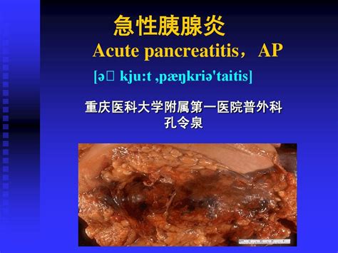 10急性胰腺炎word文档在线阅读与下载免费文档