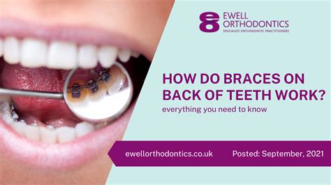 How Do Braces On Back Of Teeth Work? - Ewell Orthodontics