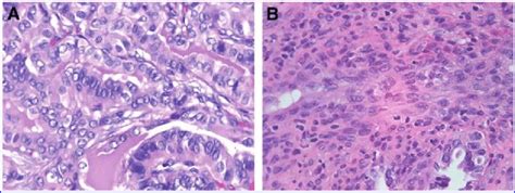 A Tall Cell Variant Papillary Thyroid Carcinoma Is Characterized By