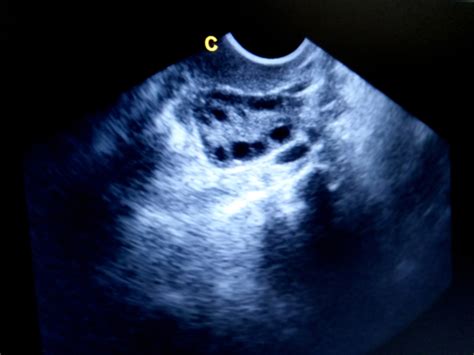 Normal Vs Polycystic Ovaries Ultrasound