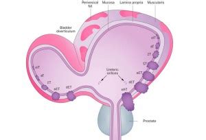 What are the symptoms of bladder diverticulum?