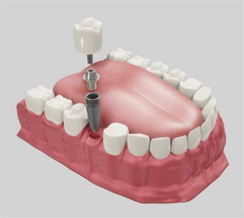 Mini Dental Implants A Good Option For Patients With Extensive Bone